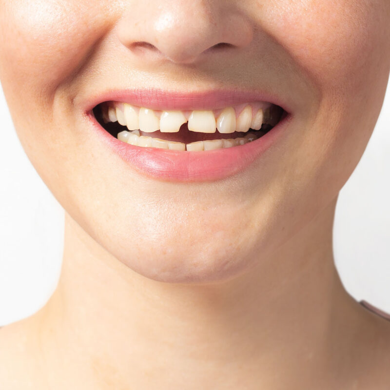 Learn how dentists in Bellevue repair a cracked or chipped tooth