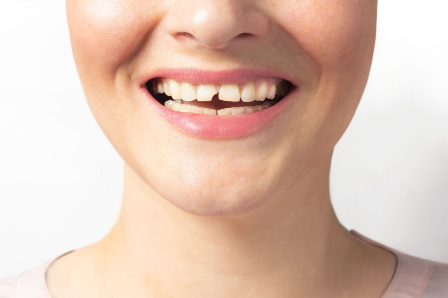 Learn how dentists in Bellevue repair a cracked or chipped tooth