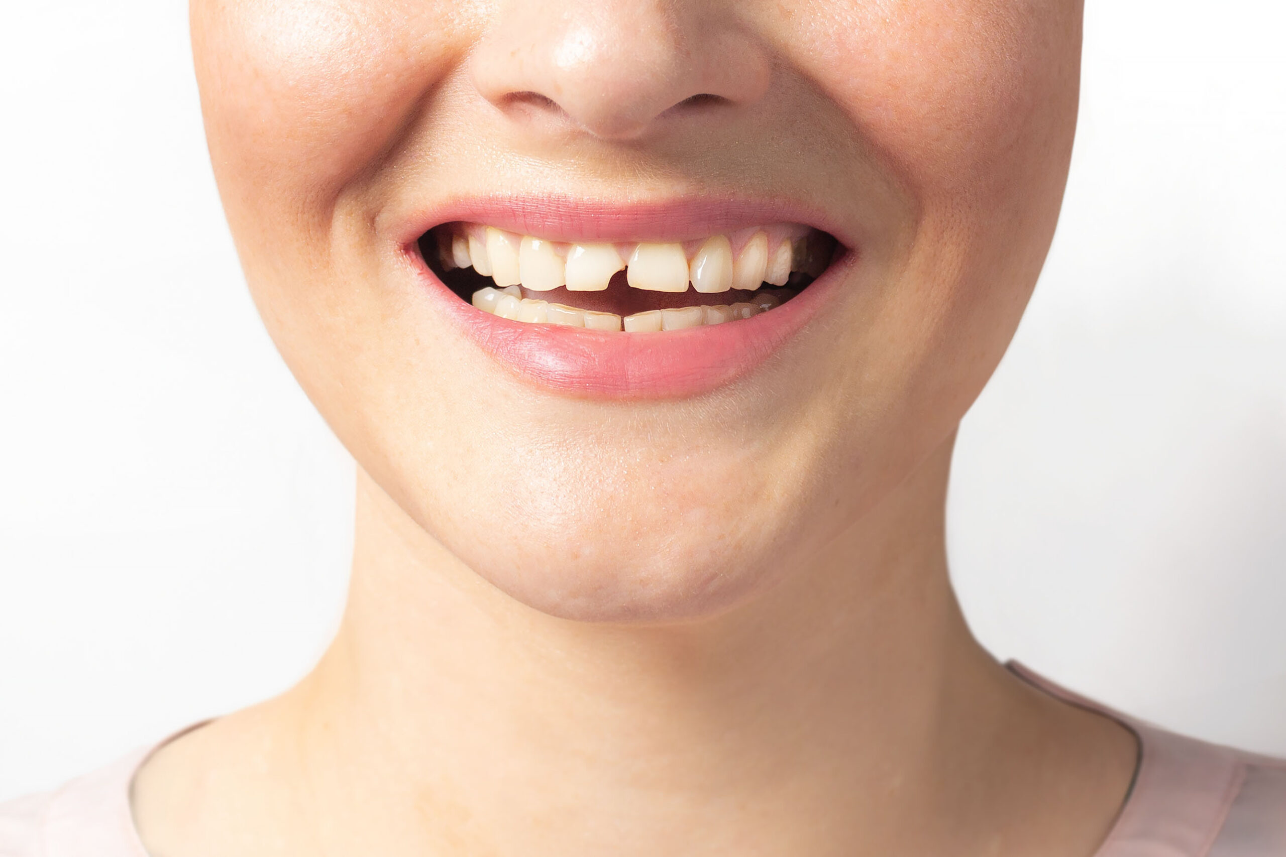 Learn how dentists in Bellevue repair a cracked or chipped tooth