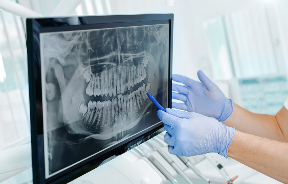 Dental X-Ray Assessment for Implant Planning - Dental Implants Gloved hands pointing at digital panoramic dental x-ray on screen, evaluating jaw and teeth structure for dental implants - Dental Implants