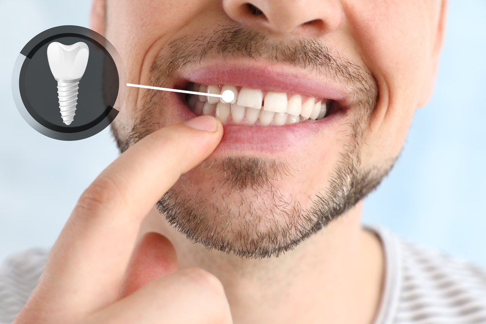 Confident Smile with Dental Implants - Dental Implants Close-up of smiling man pointing to his dental implant tooth restoration - Dental Implants