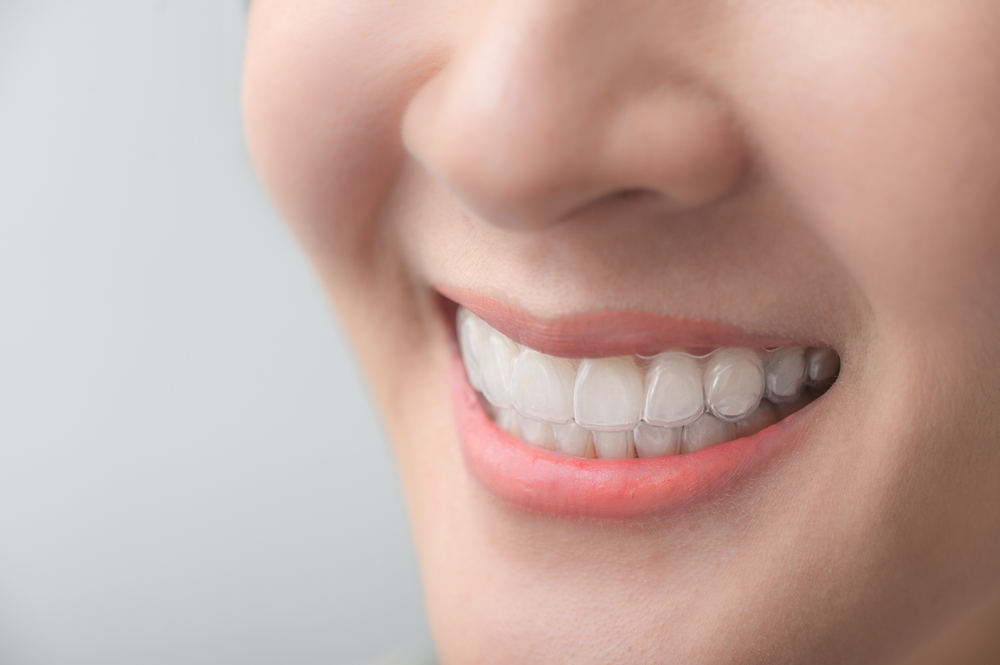 A detailed close-up of a smiling woman’s mouth showing perfectly fitted Invisalign clear aligners over her teeth – Invisalign