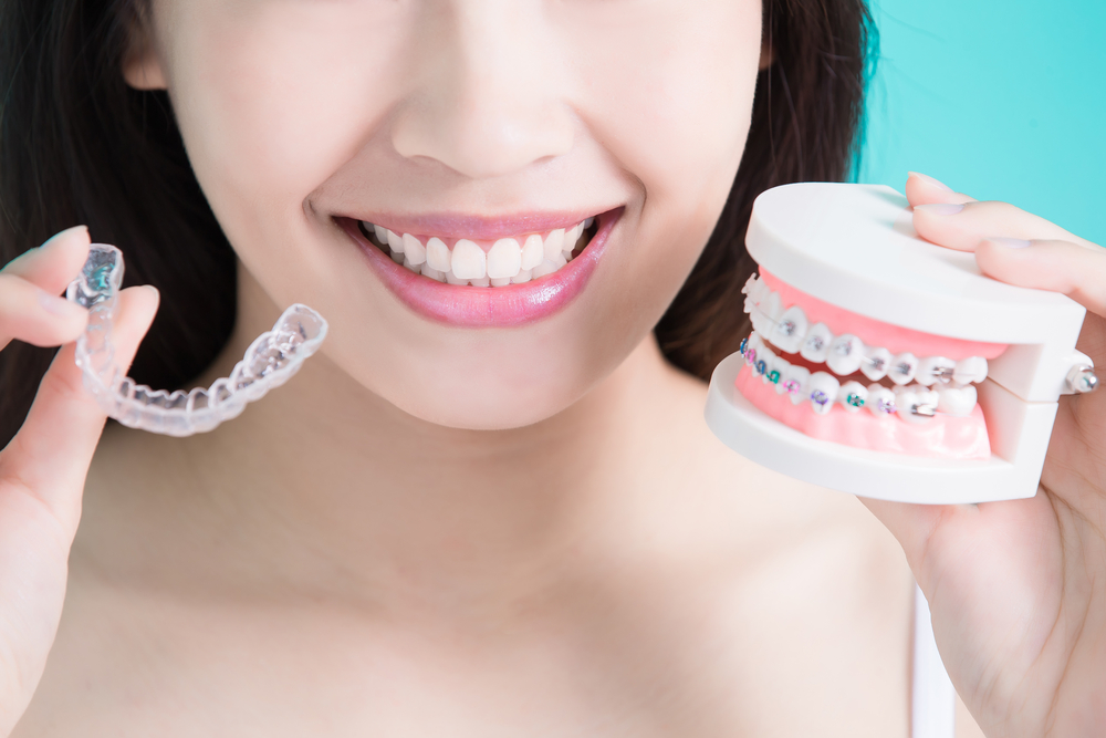 Clear Aligners vs Braces Comparison - Cosmetic Dentistry Smiling woman holding dental model and clear aligner to show orthodontic options - Cosmetic Dentistry